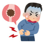尿管結石の治療方法とは｜なぜ激しく痛むの原因や予防法はあるの？